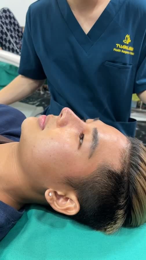Nâng mũi bọc sụn - dáng mũi sau 5 ngày tái khám
